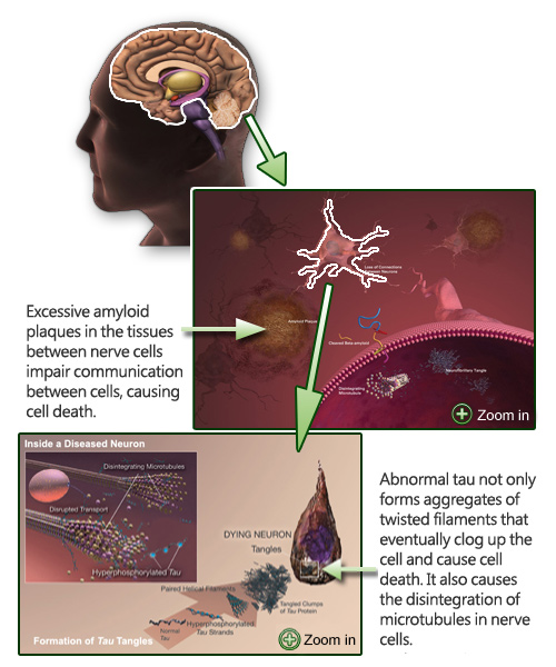 The development of Alzheimer's disease