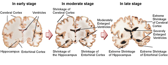 The brain of a person with Alzheimer's disease