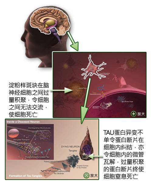 阿尔茨海默症的病因