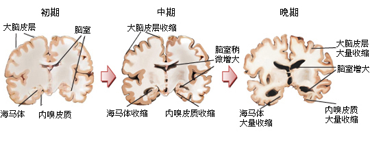 阿尔茨海默症患者脑部变化